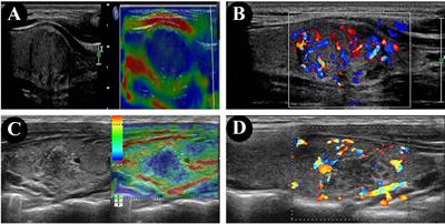 Ultrasonographic, clinical, and pathological features of papillary thyroid carcinoma in children and adolescents with or without Hashimoto’s thyroiditis